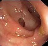 Diverticulos